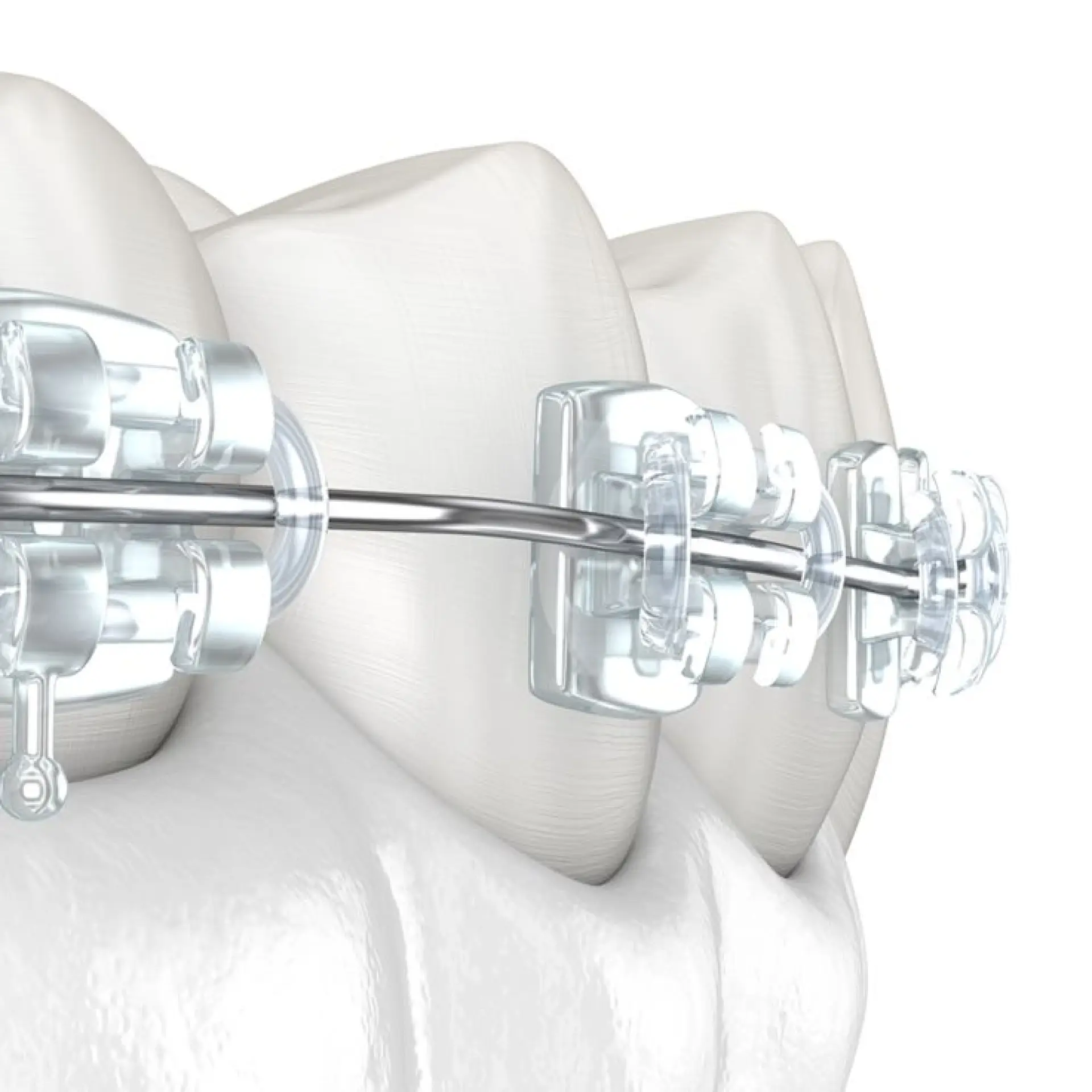 Orthodontics (Kawat Gigi)