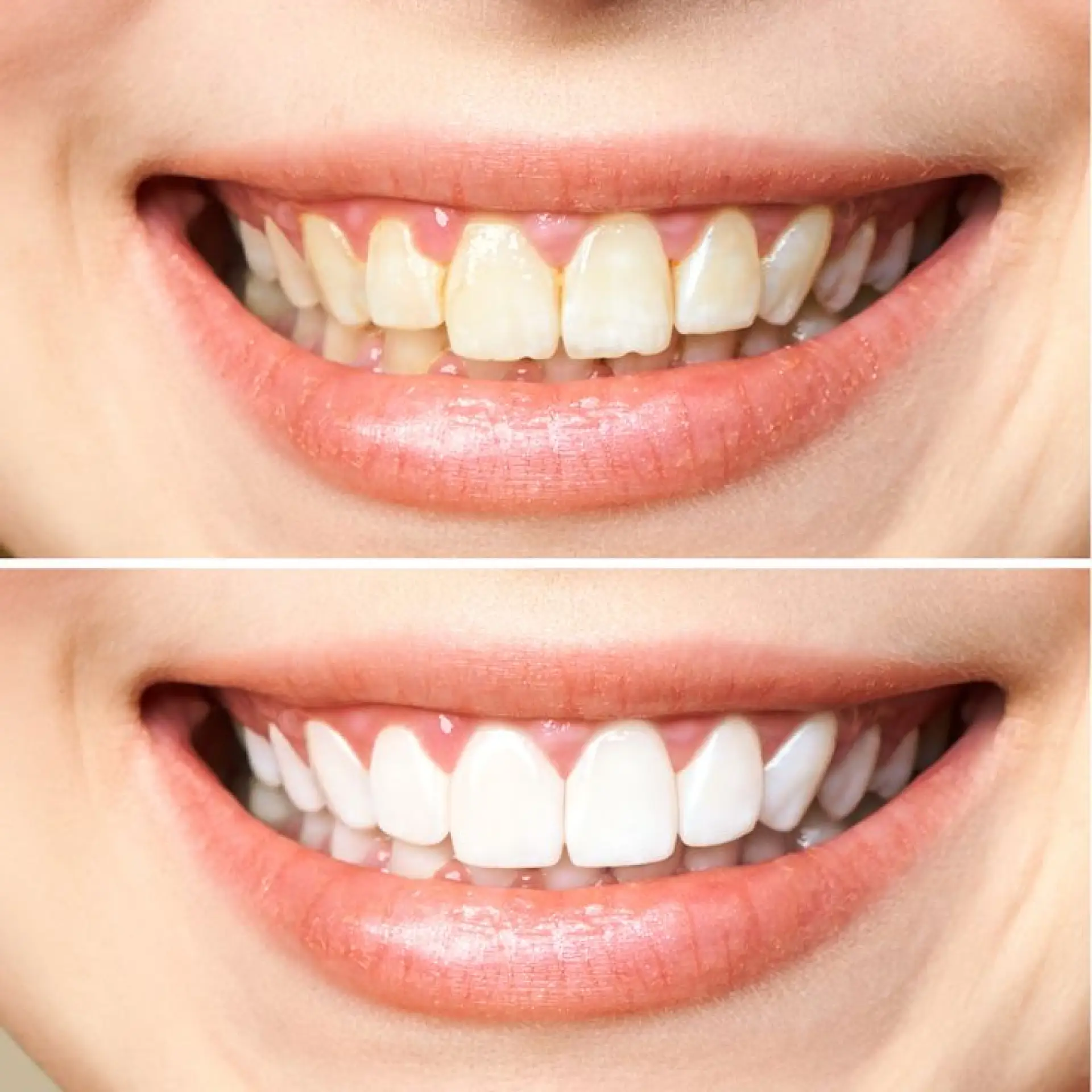 Aesthetic Dentistry (Estetika Gigi)